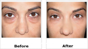eye bag removal before and after female